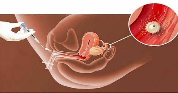 Iui - phương pháp thụ tinh nhân tạo cải thiện khả năng thụ thai