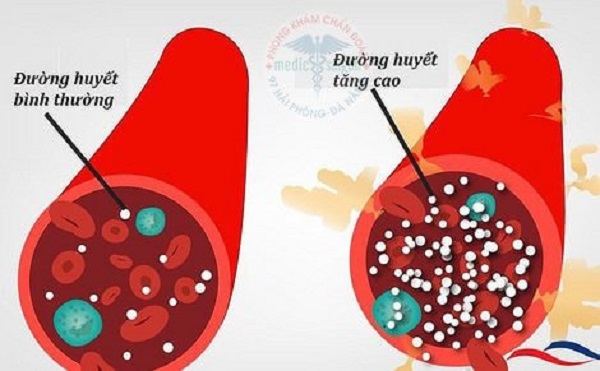 Chỉ số đường huyết tiêu chuẩn