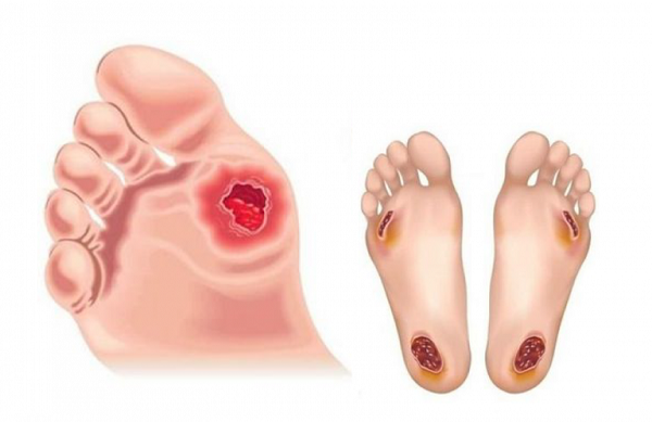 Phuơng pháp phòng ngừa và điều trị loét bàn chân tiểu đường