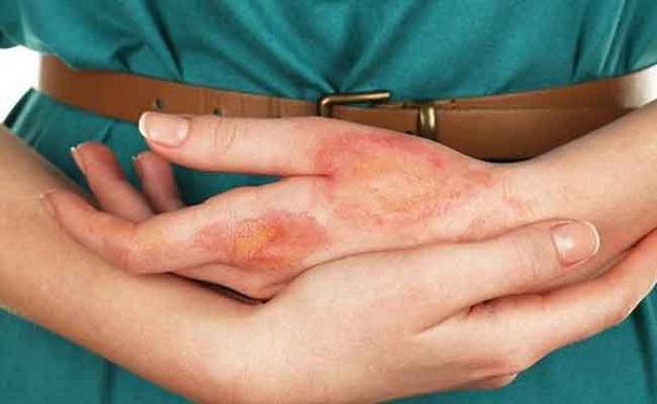 Nguyên nhân bệnh tiểu đường gây ngứa